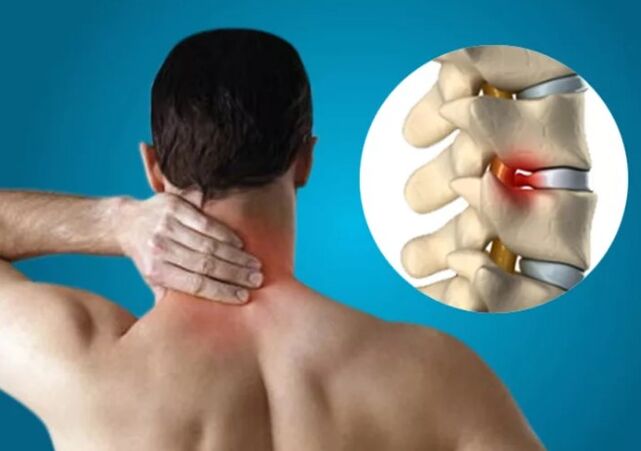 Servikal osteokondroz