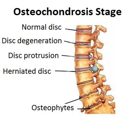 Osteokondroz aşamaları