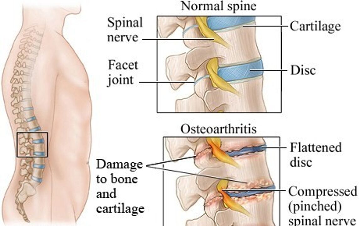 Sağlıklı bir disk ile osteokondrozlu bir disk arasındaki fark